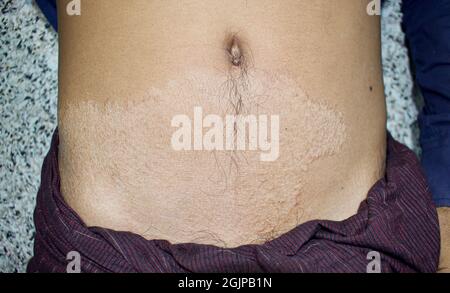 Fungal infection called tinea corporis in trunk of Asian young man. Widespread ringworm over abdomen. Stock Photo