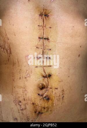 Laparotomy or midline incision at abdomen of Asian man. Closeup view. Stock Photo