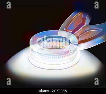 Eye (refractive surgery), Lasik: Suction ring for femtosecond laser. Stock Photo