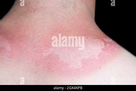 Sunburn peeling discoloration or sun burn dermatitis in the upper back of Asian young man. Stock Photo