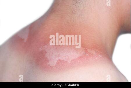 Sunburn peeling discoloration or sun burn dermatitis in the upper back of Asian young man. Stock Photo