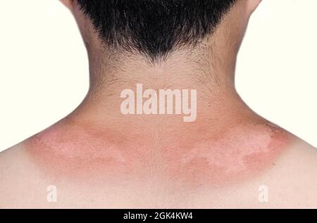 Sunburn peeling discoloration or sun burn dermatitis in the upper back of Asian young man. Stock Photo