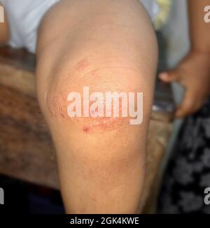 Fungal infection called tinea corporis in leg of Asian child. Widespread ringworm over knee area. Stock Photo