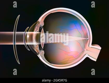 Presbyopic eye, various corrections possible: spectacle lens, - contact lens. . Stock Photo