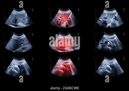 Ultrasound Upper Abdomen Showing Liver And Gall Bladder For Screening Hepatic Cell Carcinoma And