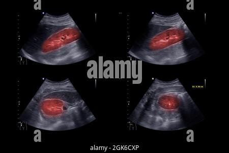 Ultrasound of Kidney  or KUB  for  screening  renal stone disease. Stock Photo