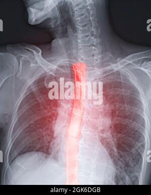 Esophagram or Barium swallow image showing Esophageal stent placement ...