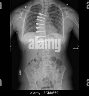 Post-operative X-rayof vertebral body tethering in Patient Boyll Stock Photo