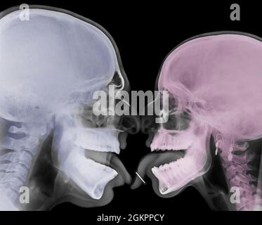 Kissing Couple. Two people kissing under x-ray pierced tongue can be seen Stock Photo