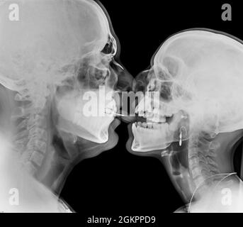 Kissing Couple. Two people kissing under x-ray pierced tongue can be seen Stock Photo