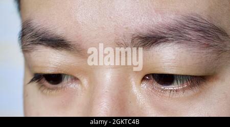 Asian single clearance eyelid