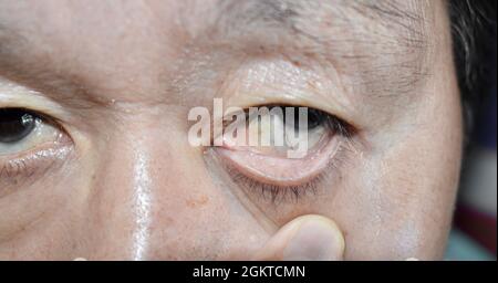 Pale skin of Asian elderly man. Sign of anemia. Pallor at eyelid. Closeup view. Stock Photo