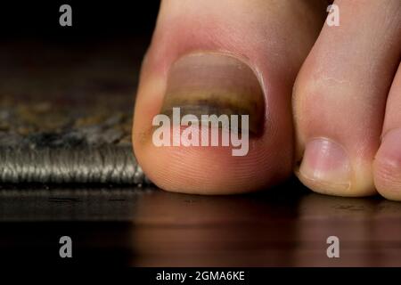 Thick nail lifted nail bed trauma and fungal infection. Dermatophyte fungus  Stock Photo - Alamy