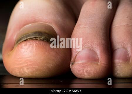 Fungal Nail Infections: Symptoms, Causes & Treatment