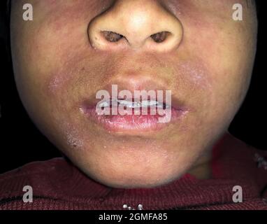 Angular stomatitis or angular cheilitis or perleche in asian little boy ...