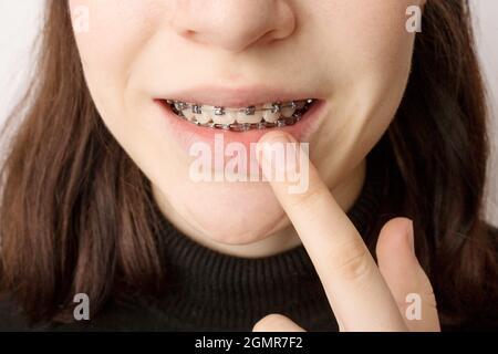 Orthodontic treatment. Dental care concept. Smiling teenage girl with braces.  Stock Photo