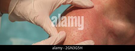 Doctor dermatologist examining rash on skin of man shoulders using gloves closeup Stock Photo