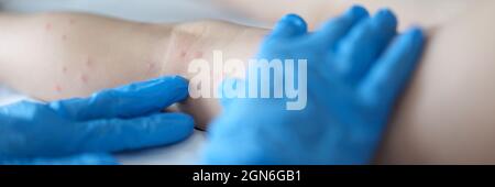 Doctor examining red rash on legs of child in clinic closeup Stock Photo