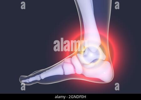 Foot pain, illustration Stock Photo