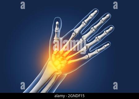 Painful wrist, illustration Stock Photo