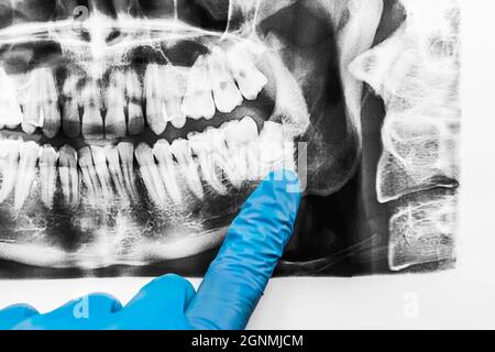 A doctor's hand in a protective medical glove points with a finger at the growth of wisdom teeth in the lower jaw on an X-ray image of the oral cavity Stock Photo