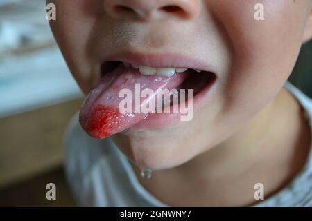 Close-up of lips, tongue, protrusion of blood. Child's bitten tongue. Stock Photo