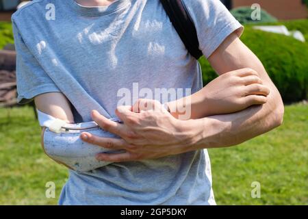Young man with disability puts on a prosthesis outdoors Stock Photo