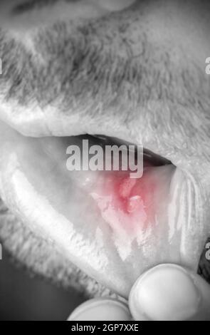 Man shows his lower lip of the mouth with aphtha Stock Photo