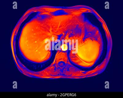 Cross section Abdomen MRI scan of a 60 year old male patient. This patient suffers from a kidney stone Stock Photo