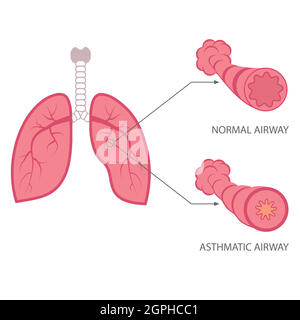 asthma, lungs respiratory disease Stock Vector