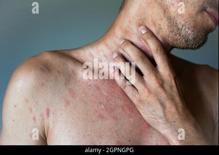 Body of adult man have spotted, red pimple and bubble rash from chickenpox or varicella zoster virus. Man with symptoms of itchy urticaria. Stock Photo