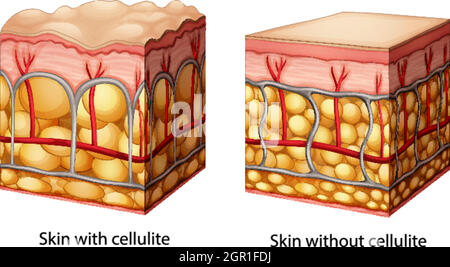 skin with cellulite cross-section of human skin layers structure ...