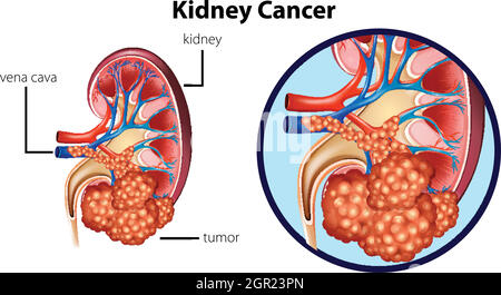 Diagram showing kidney cancer Stock Vector