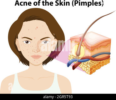 Acne of the skin on a woman Stock Vector