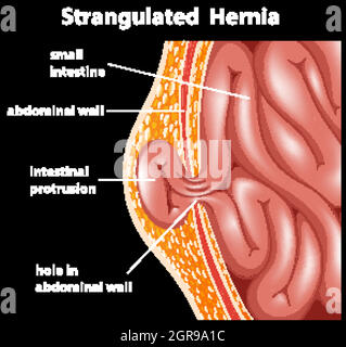 Strangulated hernia anatomy diagram illustration Stock Vector Image ...