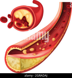 Blood with fat in vessel Stock Vector