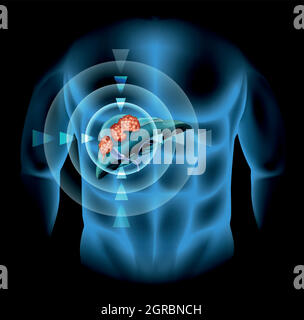 Liver cancer diagram showing details Stock Vector