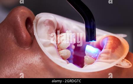 Premium Photo  Orthodontist shine an ultraviolet lamp on the