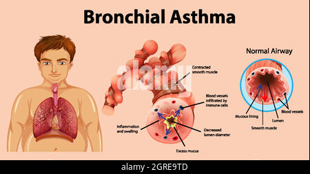 Asthma inflamed bronchial tube Stock Vector