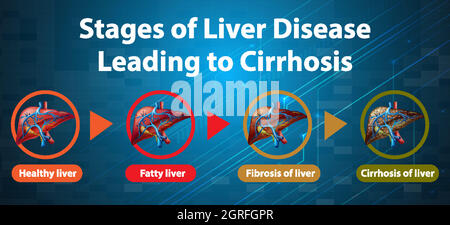 Stages of liver disease leading to Cirrhosis illustration Stock Vector ...