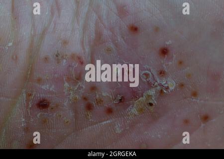 severe pustular psoriasis lesions on  the sole of the foot Stock Photo