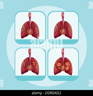 Diagram showing different stages of lung cancer illustration Stock ...