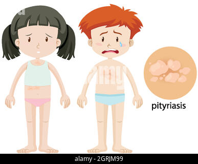 Diagram showing pityriasis in children Stock Vector