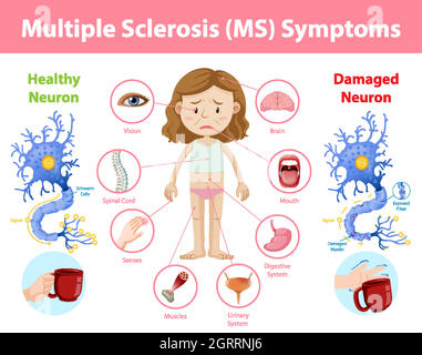 Multiple sclerosis (MS) symptoms information infographic Stock Vector