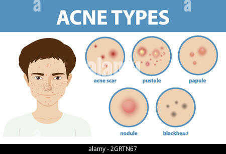 Types of acne on the skin or pimples Stock Vector