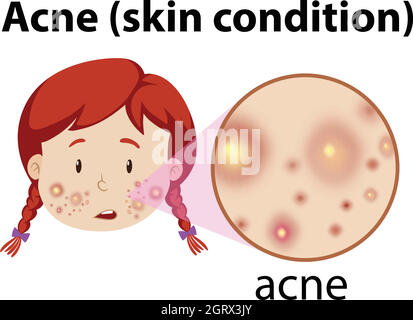 A Young Girl Having Acne Stock Vector