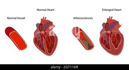 Atherosclerosis and enlarged heart, illustration Stock Photo