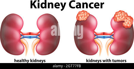 Diagram showing kidney cancer in human Stock Vector
