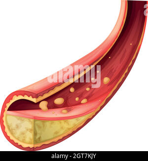 Artery blocked with cholesterol Stock Vector