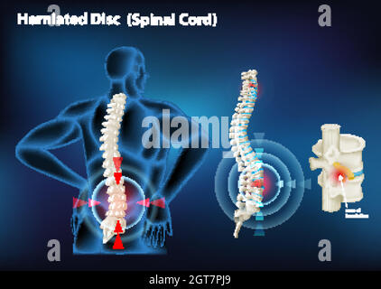 Diagram showing herniated disc in human Stock Vector